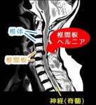 頚椎椎間板ヘルニアとの闘い!!のアイキャッチ画像